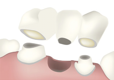 dental-bridge