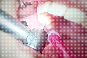 fillings2