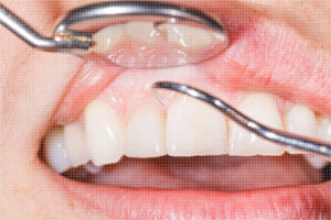 gumdisease