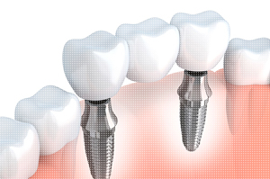 implants2