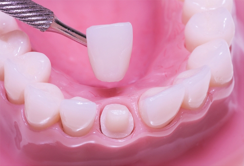 porcelain-crown-placement