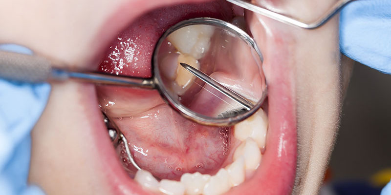 caries-dentaire_dentistes-drummondville-800x400