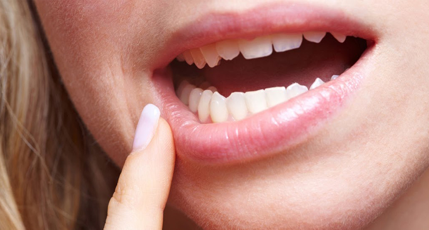 Wisdom Tooth