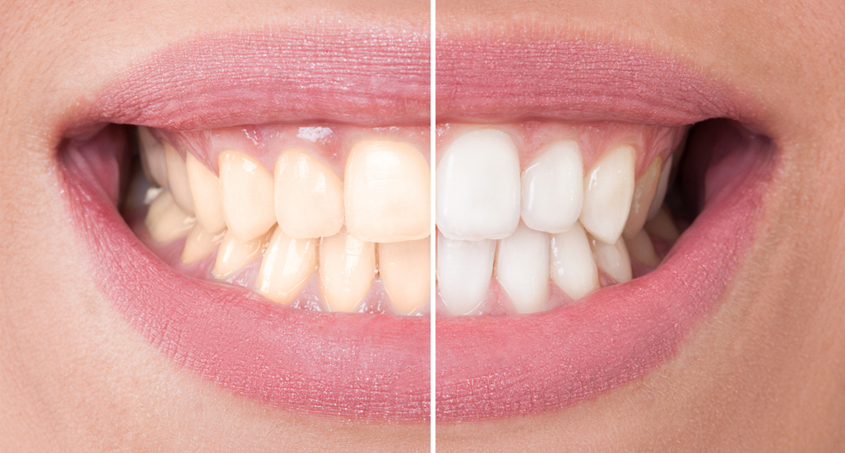Natural Whitening