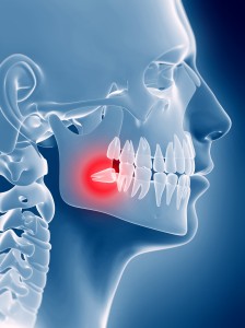 wisdom-teeth-whats-the
