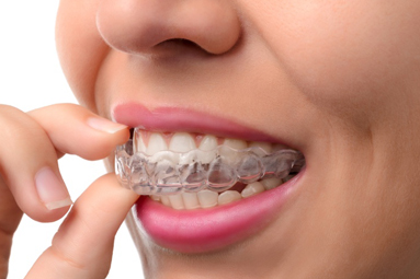 invisalign1