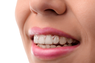 invisalign2