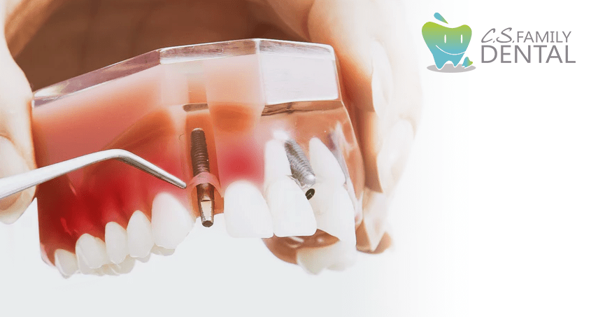 Dental Implants: How Periodontal Disease Affects Them